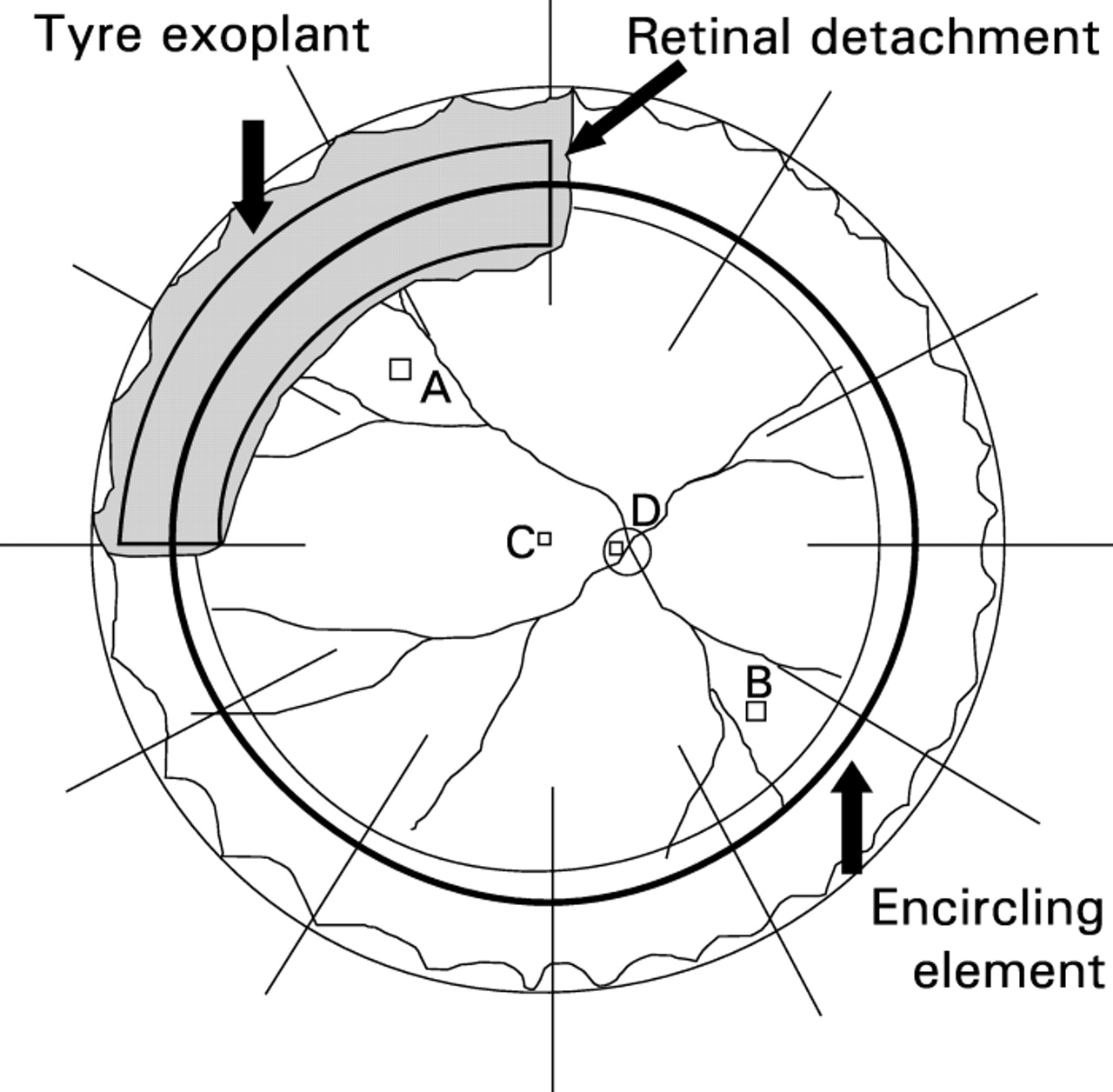 1280x1256 Effects Of Scleral Buckling And Encircling Procedures On Human