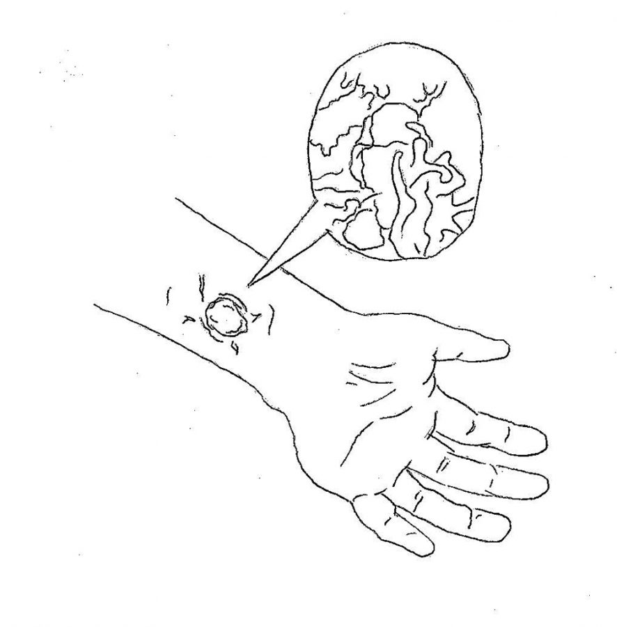 886x900 Mrsa Season Strikes Hereford Harbinger