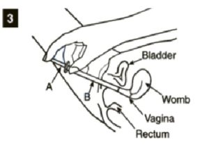 300x223 2 X Clotrimazole Thrush Treatment Pessary With Applicator 500mg