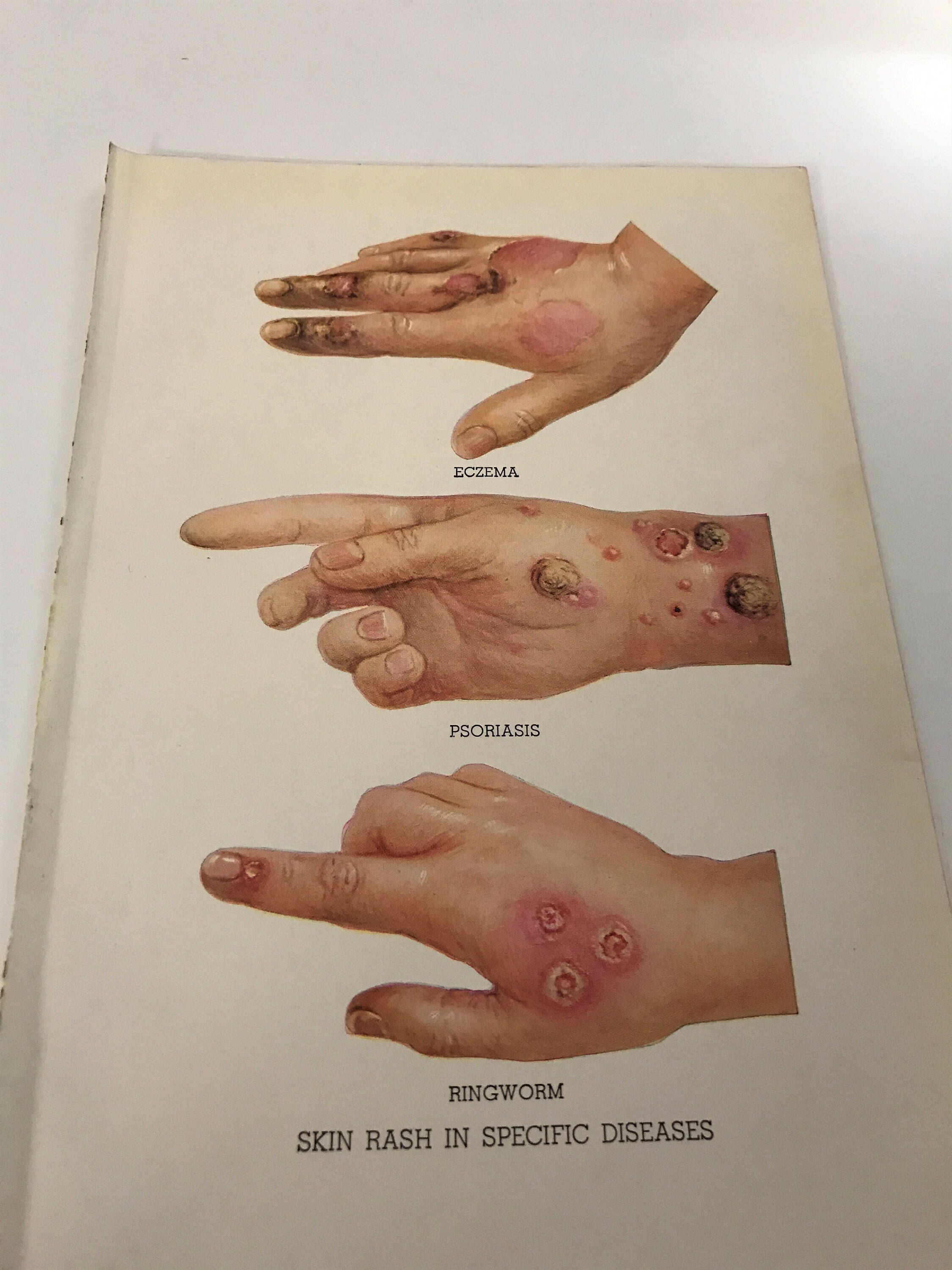 2250x3000 Antique Unique Medical Bookplate Skin Rash Diseases Eczema