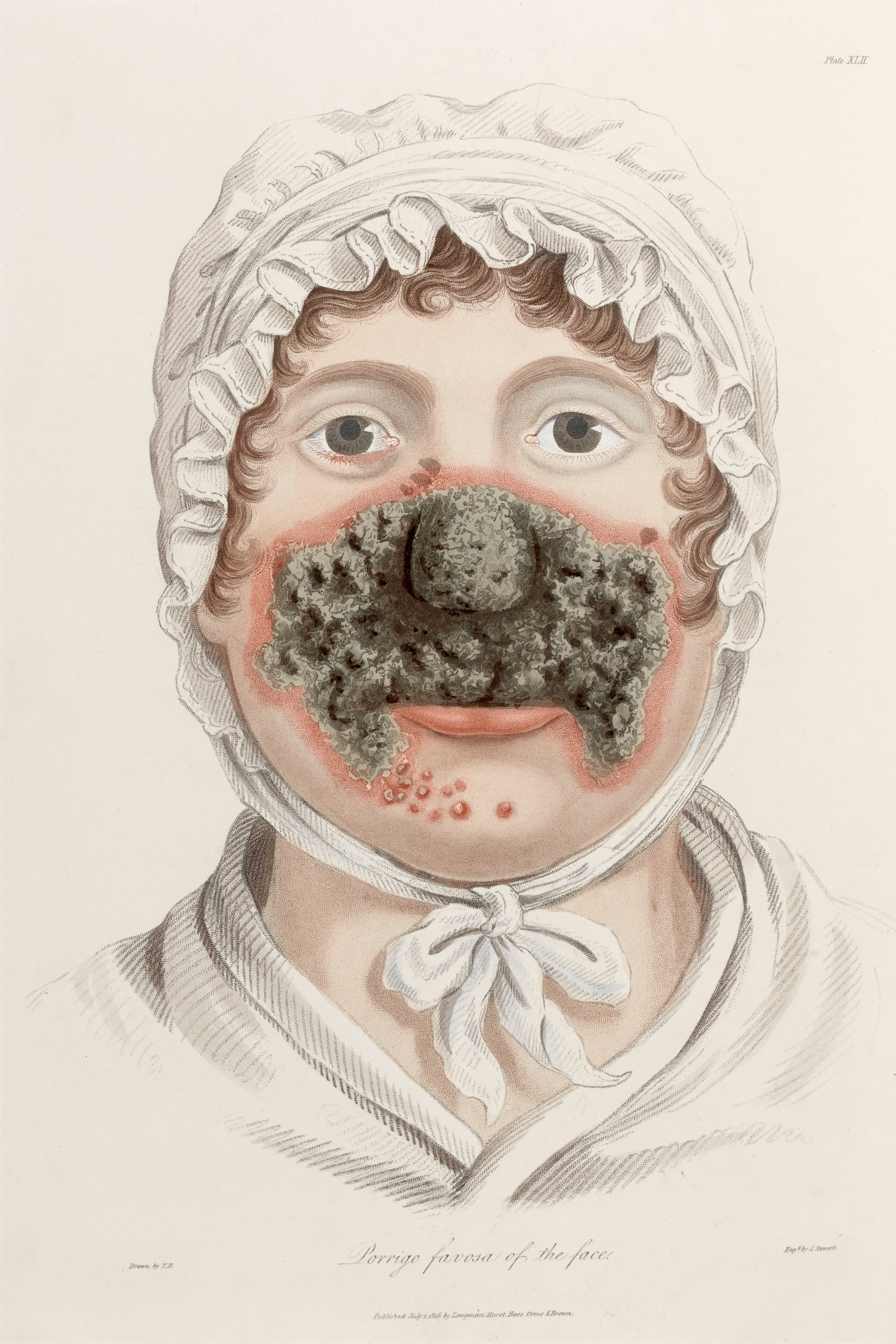 2672x4008 Fileporrigo Favosa Affecting The Face Wellcome L0034551.jpg