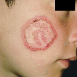 250x250 Ringworm Definition Of Ringworm By Medical Dictionary
