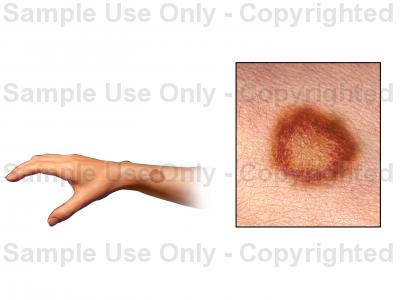 400x300 Ringworm Rash
