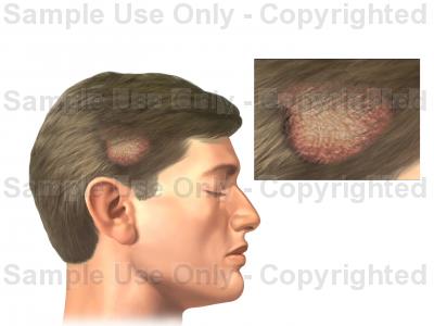 400x300 Ringworm Of The Scalp
