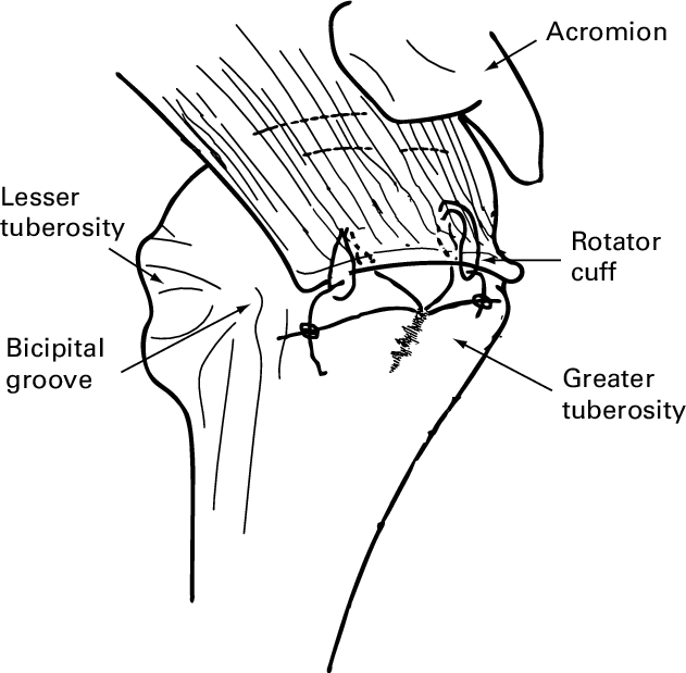 631x619 Drawing Of The Ratchet Loop Technique For Lateral Row Arthroscopic