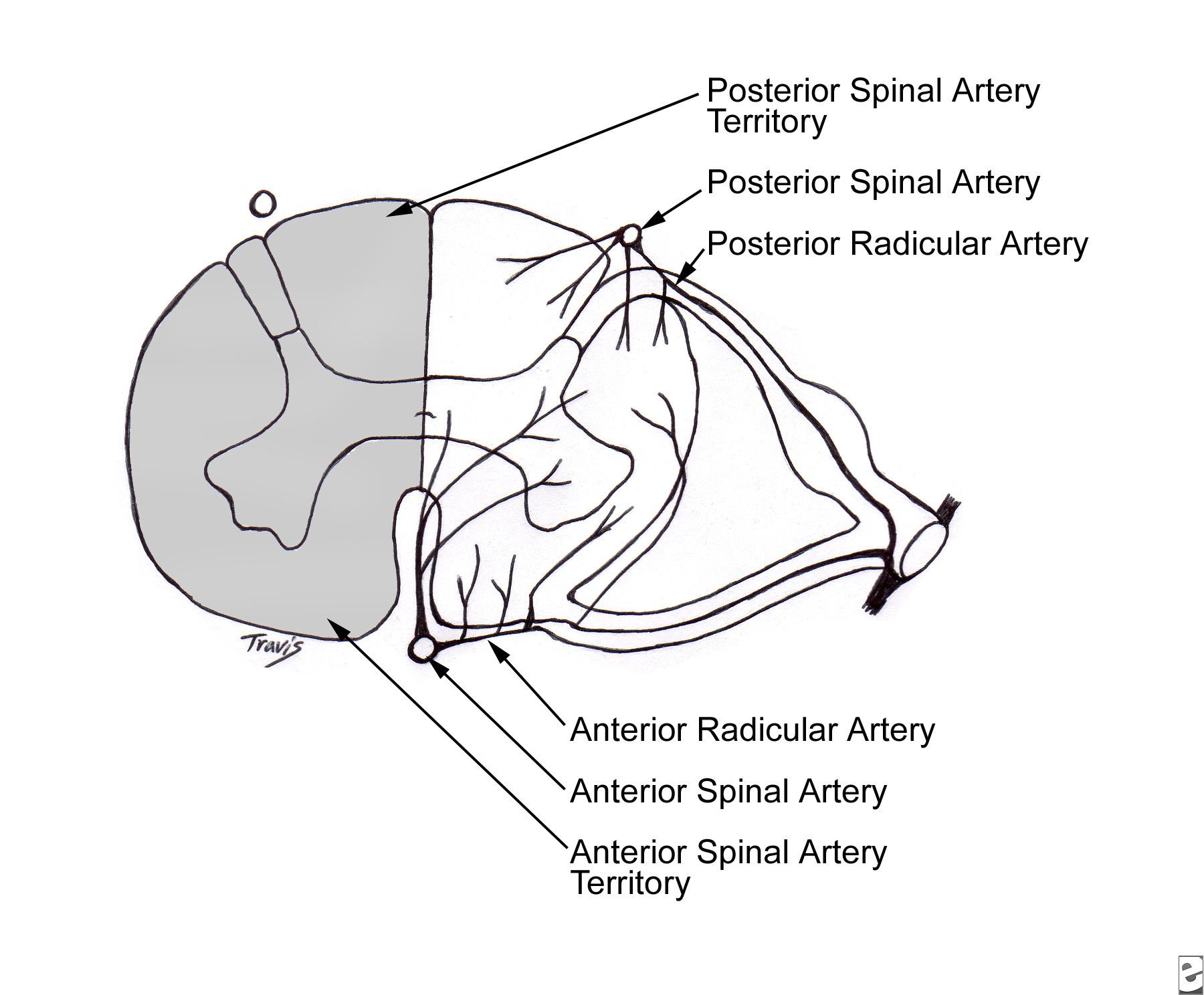 1800x1488 Spinal Cord Infarction