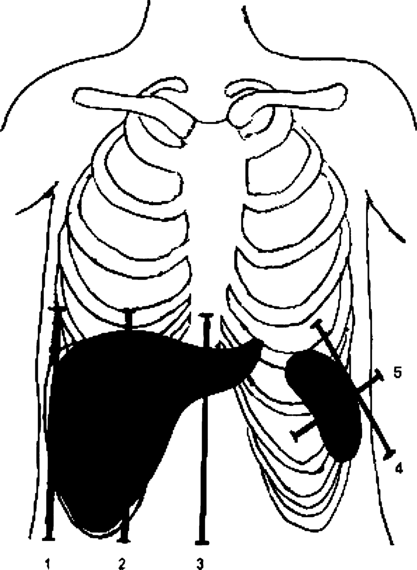 850x1161 Section Planes Of Liver And Spleen. 1 Anterior Axillary Line (Aal
