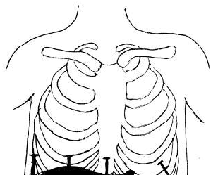 309x249 Section Planes Of Liver And Spleen. 1= Anterior Axillary Line (Aal