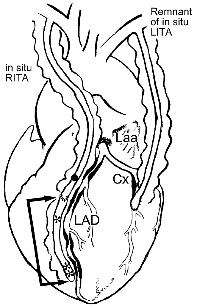 662x1027 Schematic Drawing Shows The Surgical Strategy For Sequential