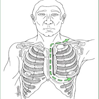 320x320 The Trapdoor Incision. Download Scientific Diagram