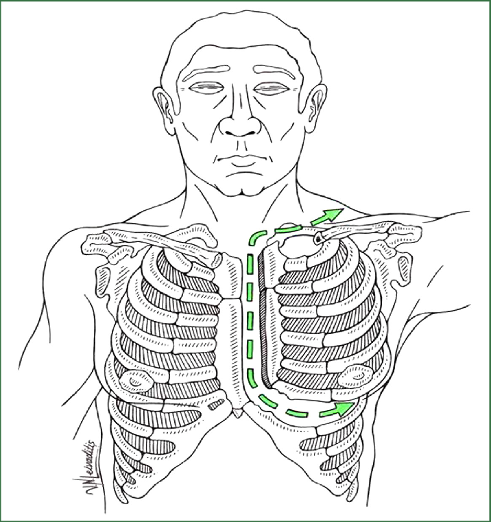 716x761 The Trapdoor Incision. Download Scientific Diagram