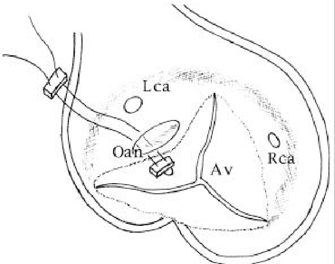 666x526 Drawing Shows Surgical Treatment Oval Opening