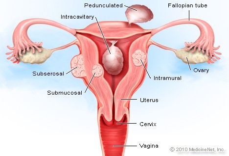 468x318 Uterine Fibroids Picture Image