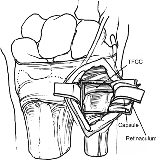 316x324 Open Procedure Musculoskeletal Key