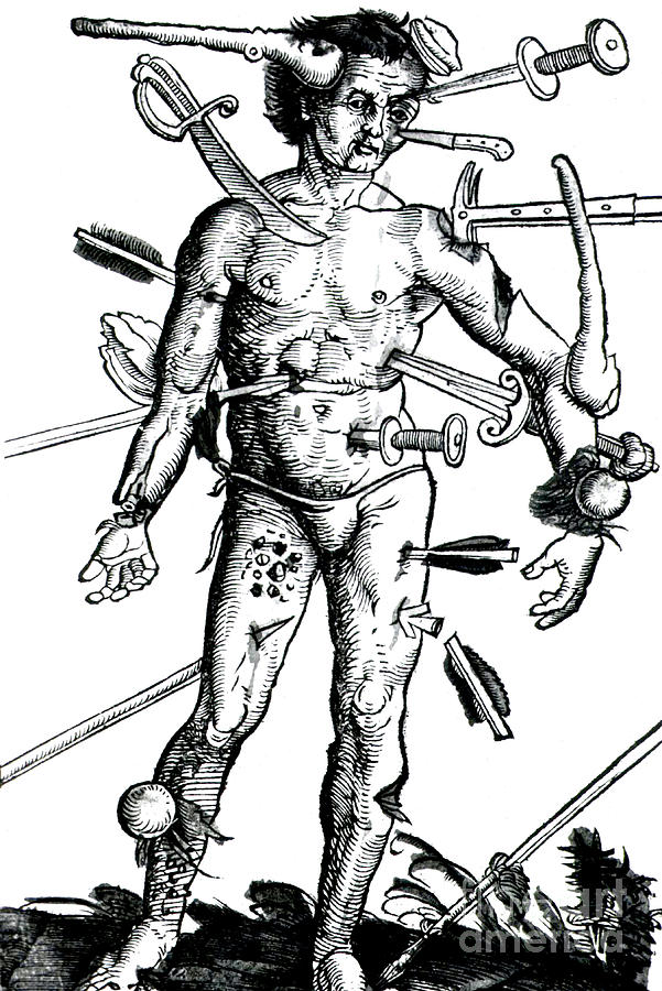 601x900 Wound Man 1517 Photograph By Science Source