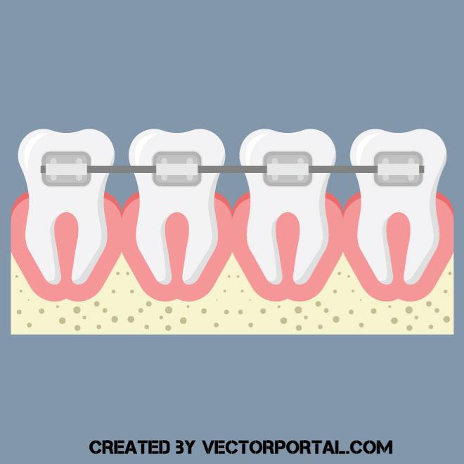 660x660 Dental Braces Vector Clip Art