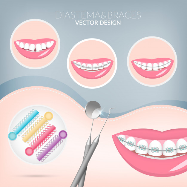 626x626 Dentistry Instruments Metal Braces Vector Premium Download