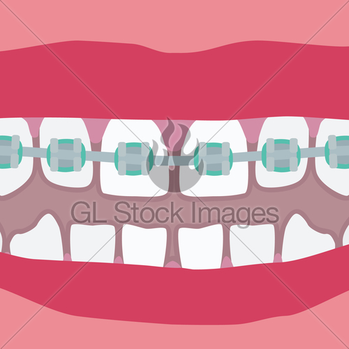 500x500 Teeth With Braces Gl Stock Images