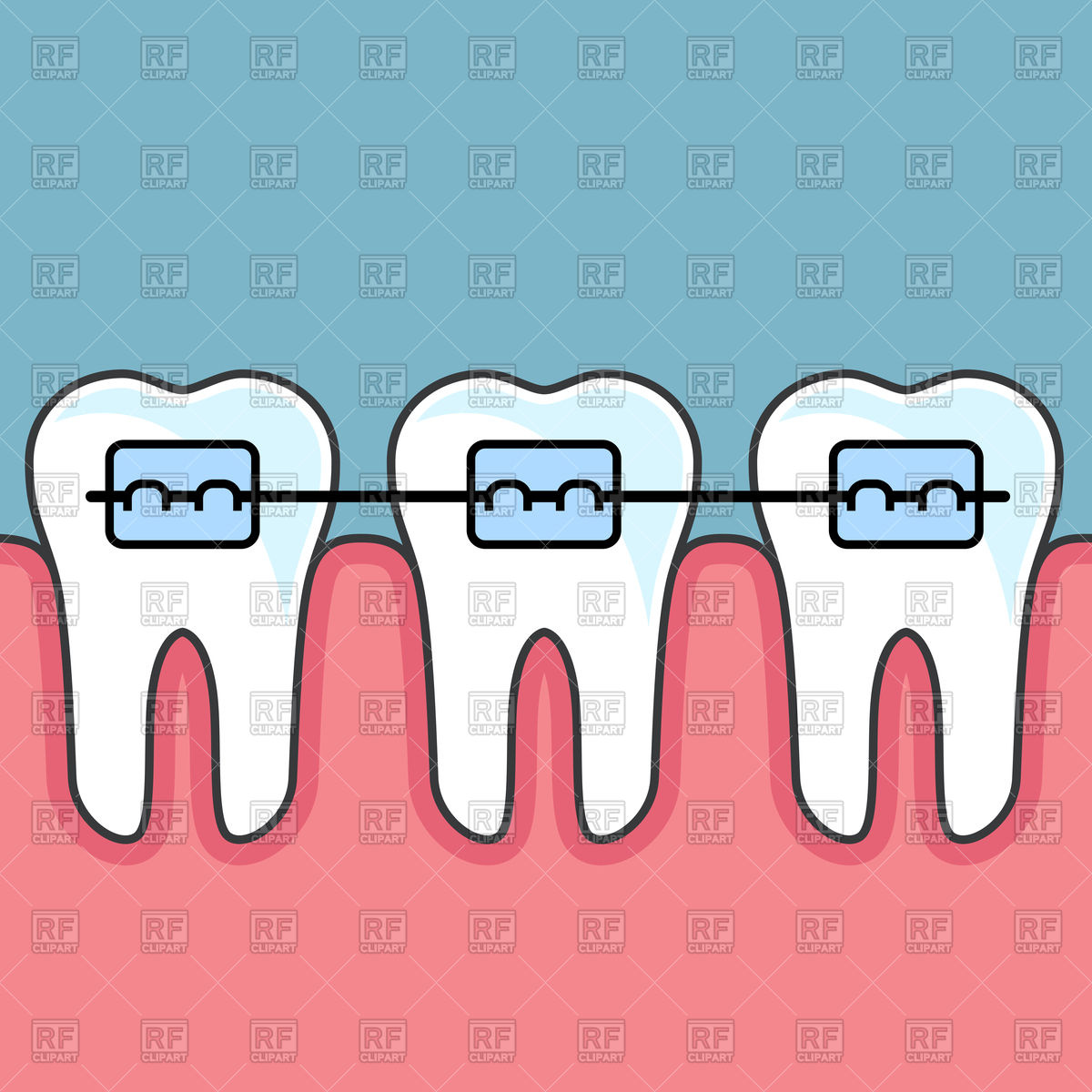 1200x1200 Teeth With Dental Braces