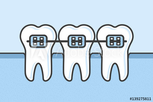 500x334 Teeth With Dental Braces Vector Illustration