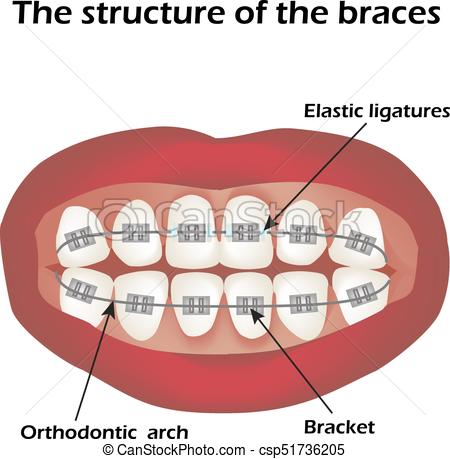 450x459 The Structure Of The Braces. Orthodontics. Infographics. Vector