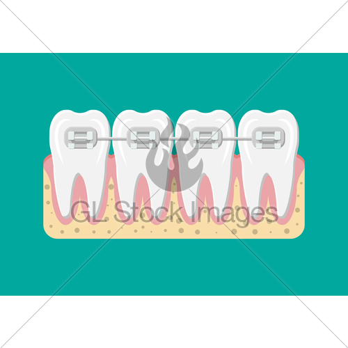 500x500 Vector Teeth Braces Flat Illustration Gl Stock Images