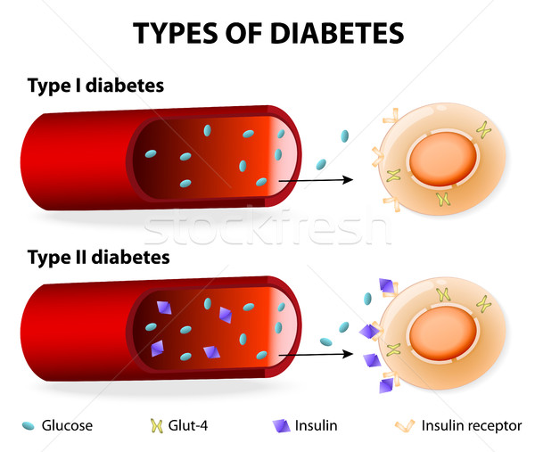 600x507 Types Of Diabetes Vector Illustration Tetiana Zhabska (Designua