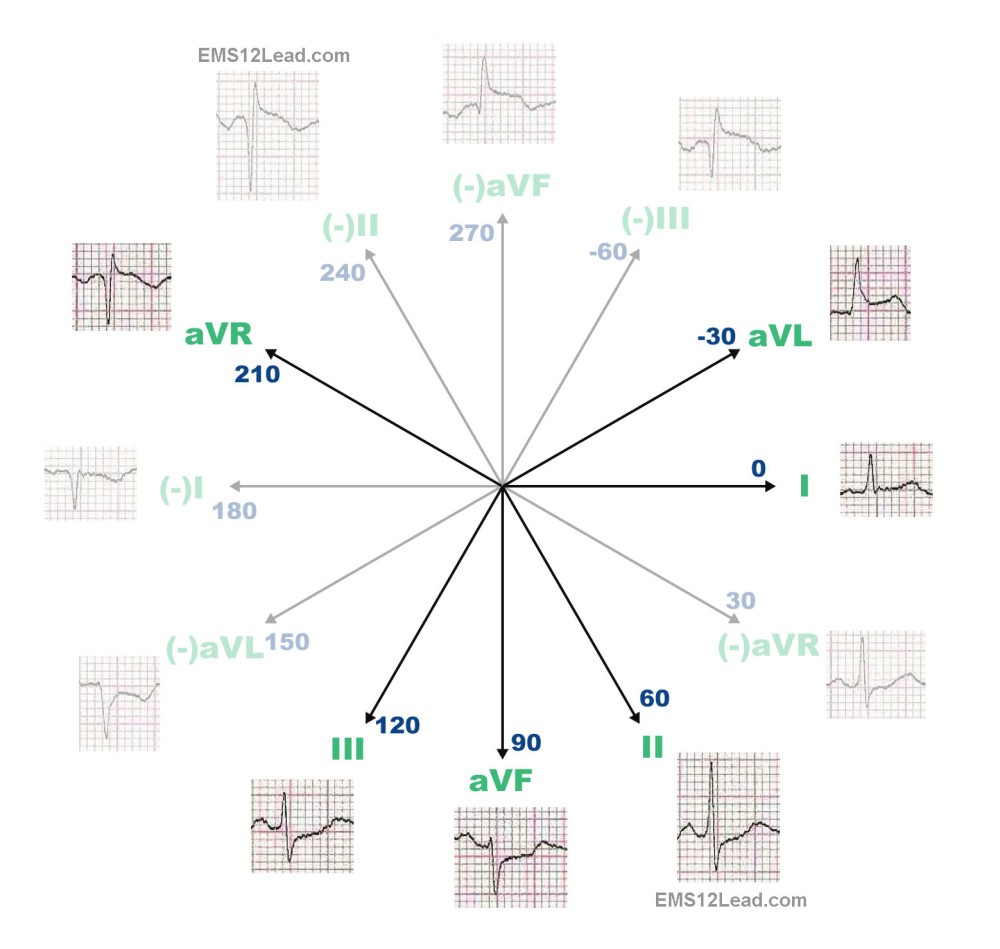 1000x949 The 360 Degree Heart Part Ii Ems 12 Lead
