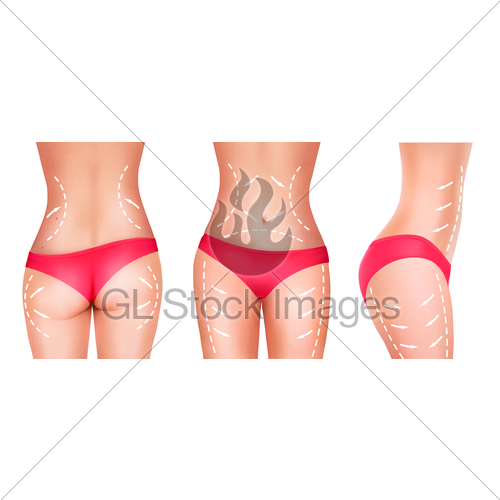 500x500 Lines, Showing Surgery On Female Body. Vector. Gl Stock Images