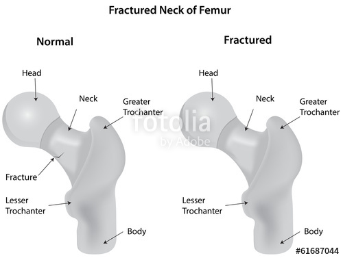 500x377 Fractured Neck Of Femur Stock Image And Royalty Free Vector Files