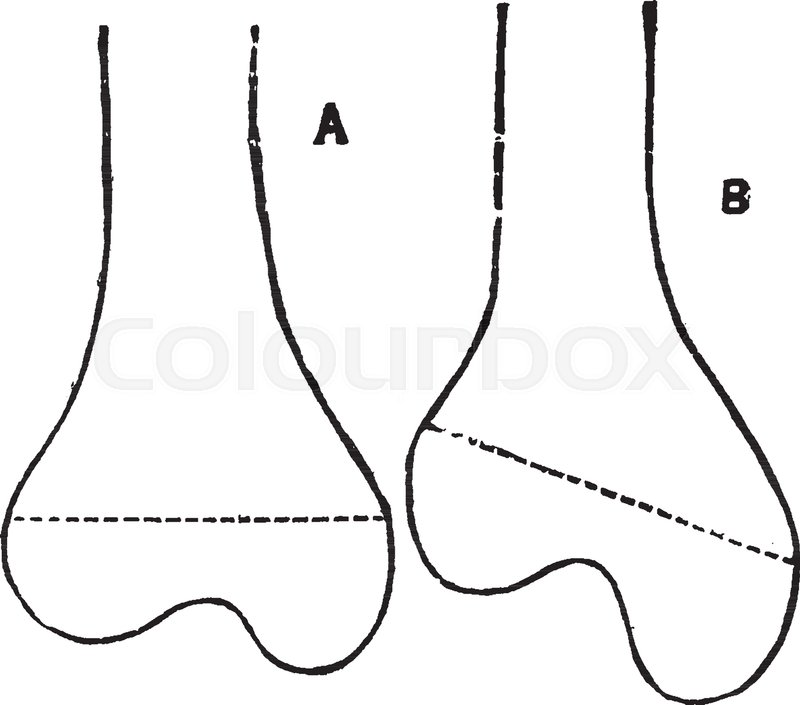 800x705 This Illustration Represents Femur In Knock Knee, Vintage Line