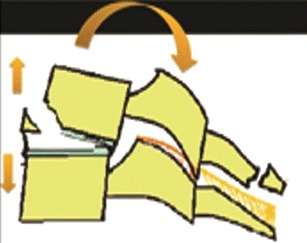 307x243 Schematic Showing Hyperextension Distraction Injury. Extension