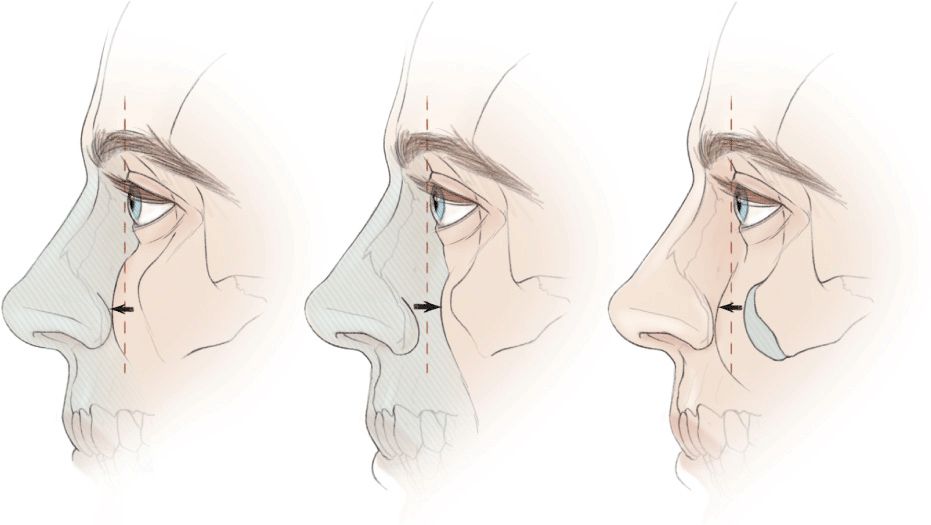 931x525 Midface Rejuvenation Plastic Surgery Key