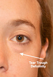 173x250 Negative Canthal Tilt Explained [Scientific]