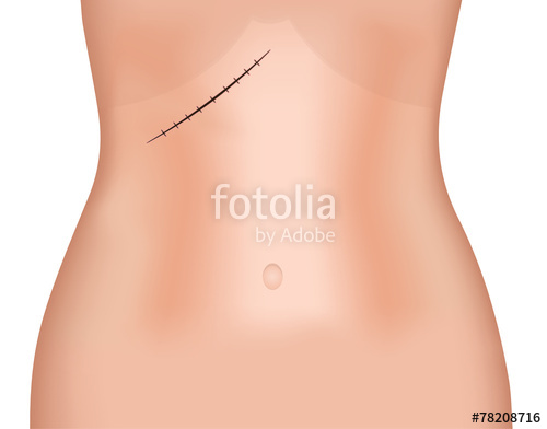 500x392 Subcostal Incision Scar Stock Image And Royalty Free Vector Files