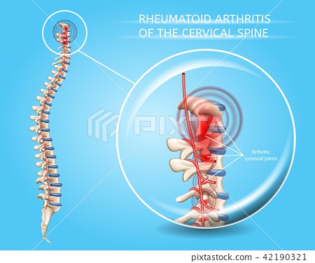 450x376 Rheumatoid Arthritis Of Cervical Spine Vector