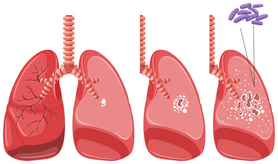 406x240 Tuberculosis Photos, Royalty Free Images, Graphics, Vectors