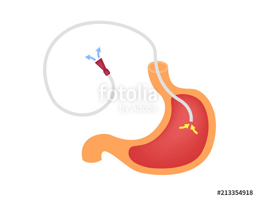 500x387 Ng Tube Vector Nasogastric Tube Stock Image And Royalty Free