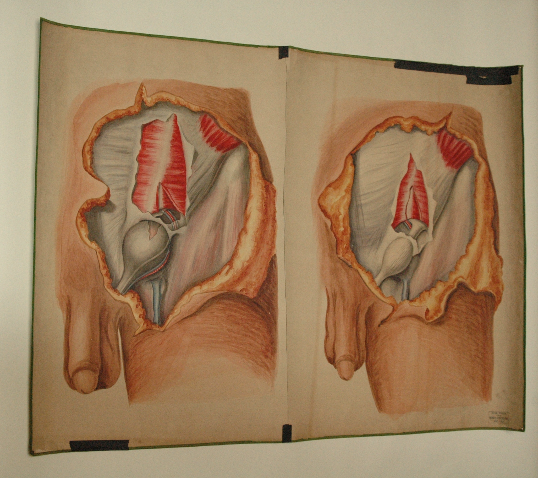 2250x2000 Teaching Watercolor Of Male With Inguinal Hernia, After Richard